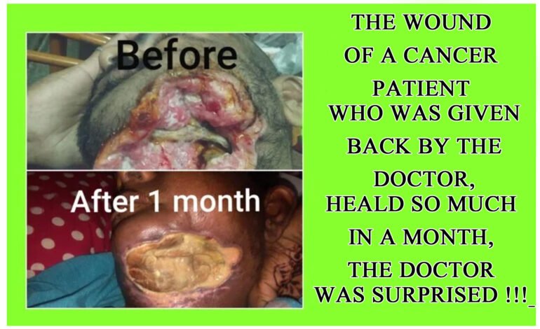 The throat cancer wound was healing