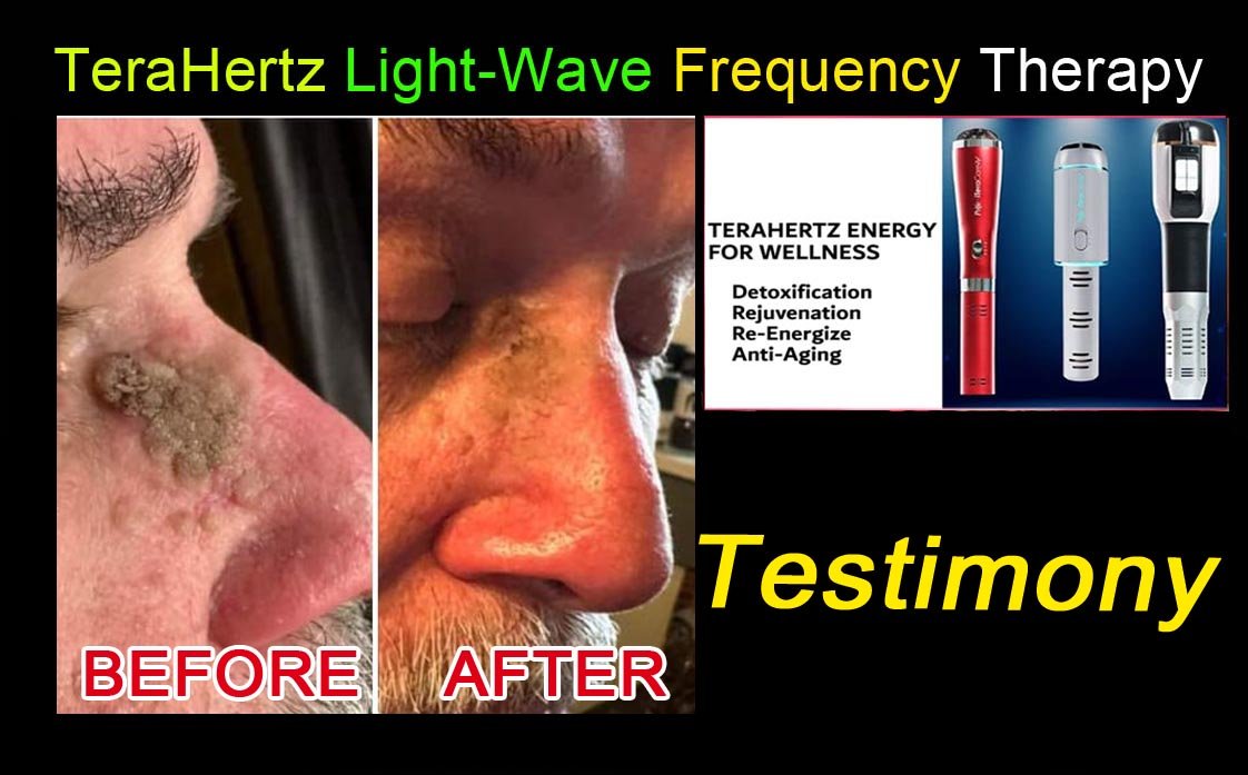 Terahertz Therapy Testimony Photos